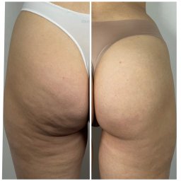 Jarosław Nemno - Porównanie obszaru ud i pośladków przed i po zabiegu, widoczne zmniejszenie cellulitu po prawej stronie.