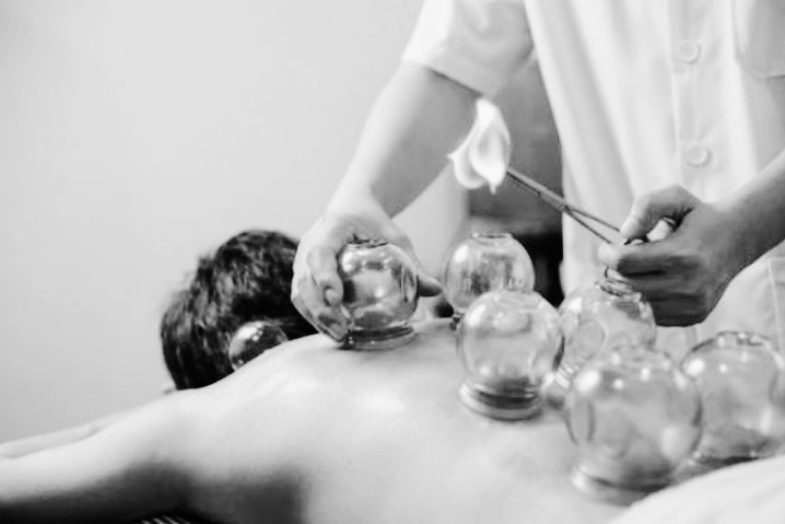 Czarno-białe zdjęcie: terapeuta wykonuje zabieg stawiania baniek na plecach pacjenta, używając płonącego wacika i szczypiec.
