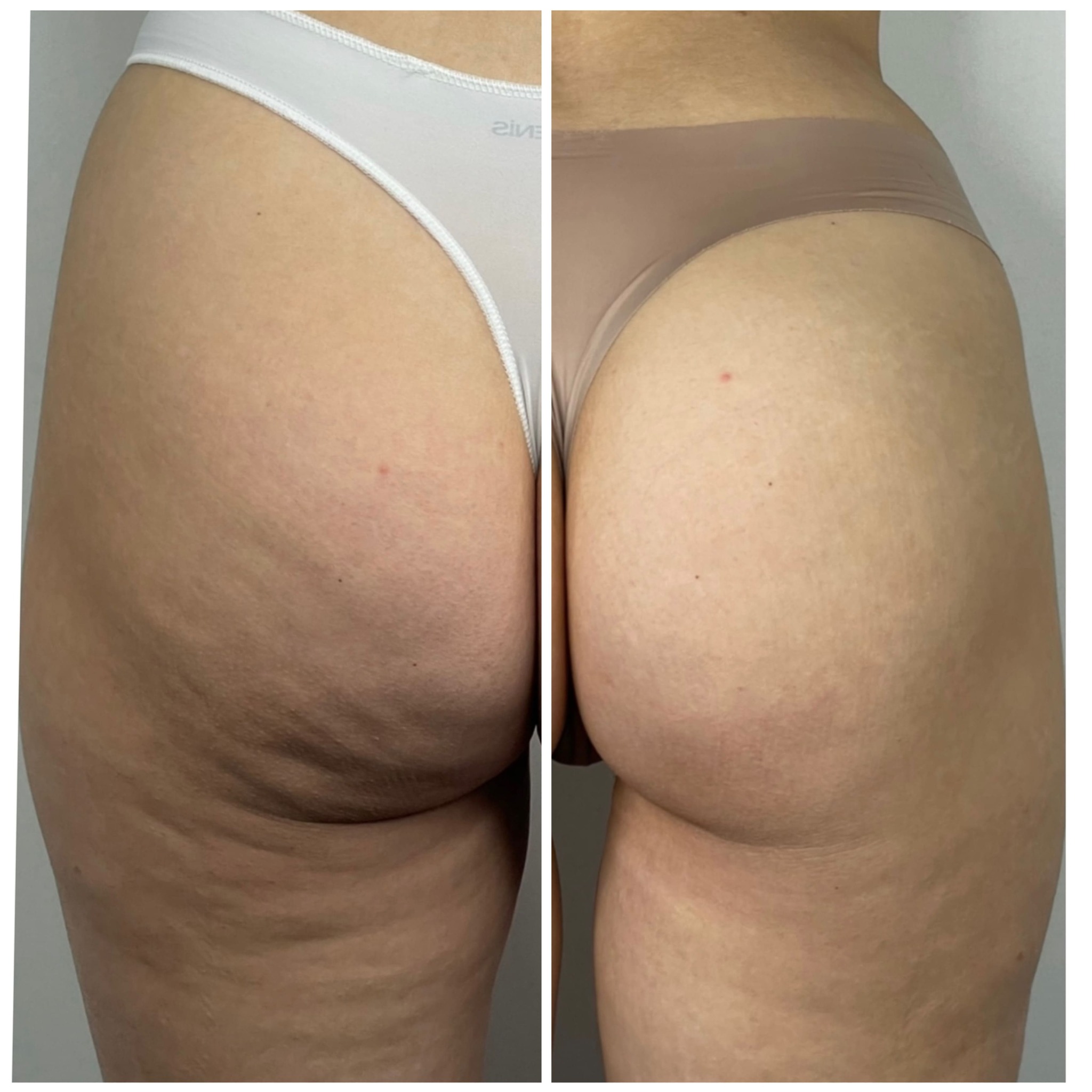 Porównanie obszaru ud i pośladków przed i po zabiegu, widoczne zmniejszenie cellulitu po prawej stronie.