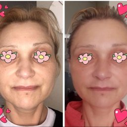 Mind & Body - Studio masażu Kobido - Porównanie stanu skóry twarzy kobiety przed i po zabiegu kosmetycznym, widoczne różnice w kolorycie i gładkości skóry, zakryte oczy naklejkami kwiatków, dodane naklejki z serduszkami.