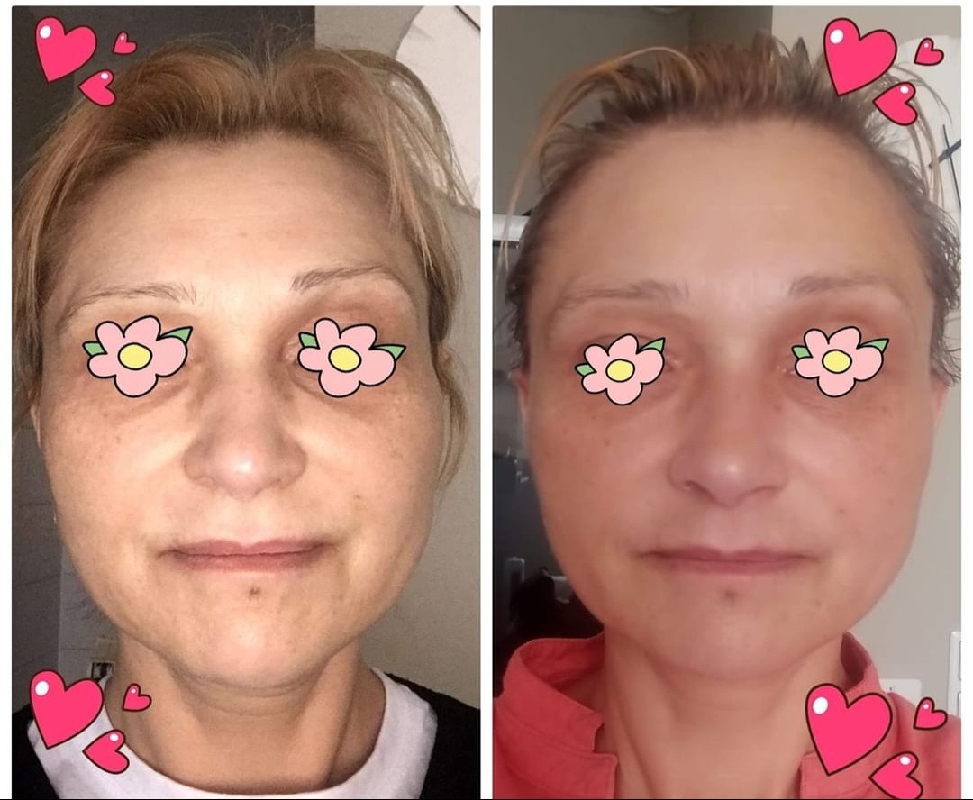Porównanie stanu skóry twarzy kobiety przed i po zabiegu kosmetycznym, widoczne różnice w kolorycie i gładkości skóry, zakryte oczy naklejkami kwiatków, dodane naklejki z serduszkami.