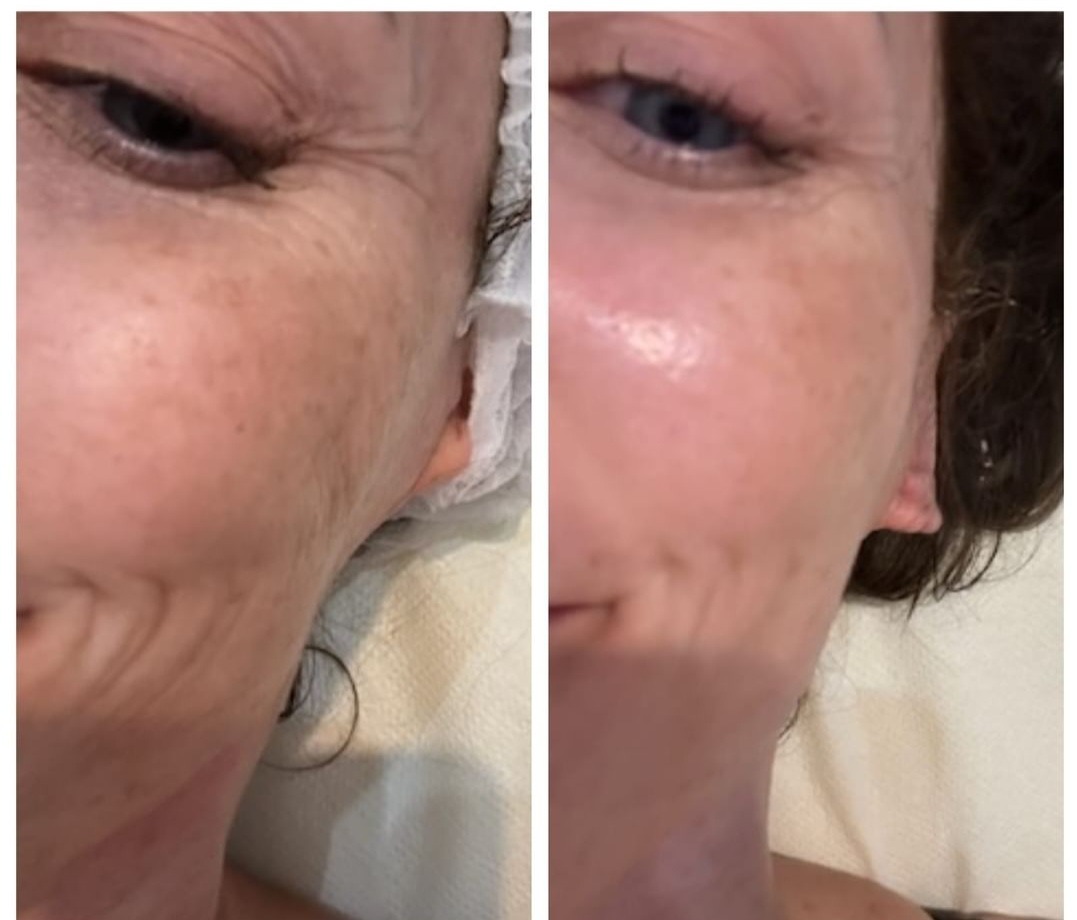 Porównanie skóry twarzy przed i po zabiegu kosmetycznym: redukcja zmarszczek i przebarwień, widoczna poprawa nawilżenia i kolorytu.