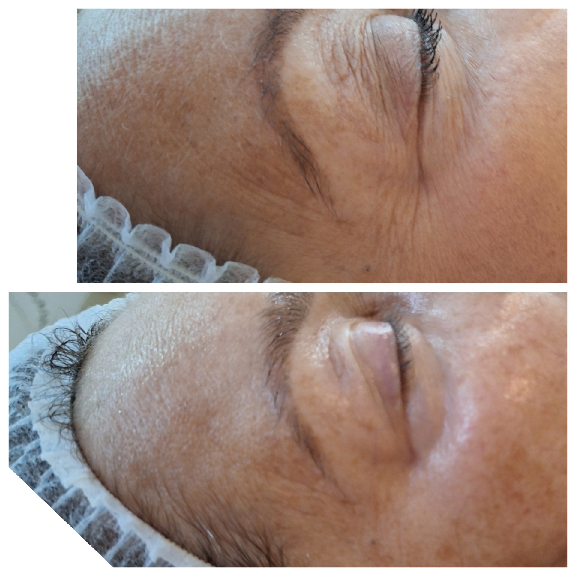 Zbliżenie twarzy klientki przed i po zabiegu kosmetycznym w okolicy oka, widoczne zmarszczki i poprawa napięcia skóry.