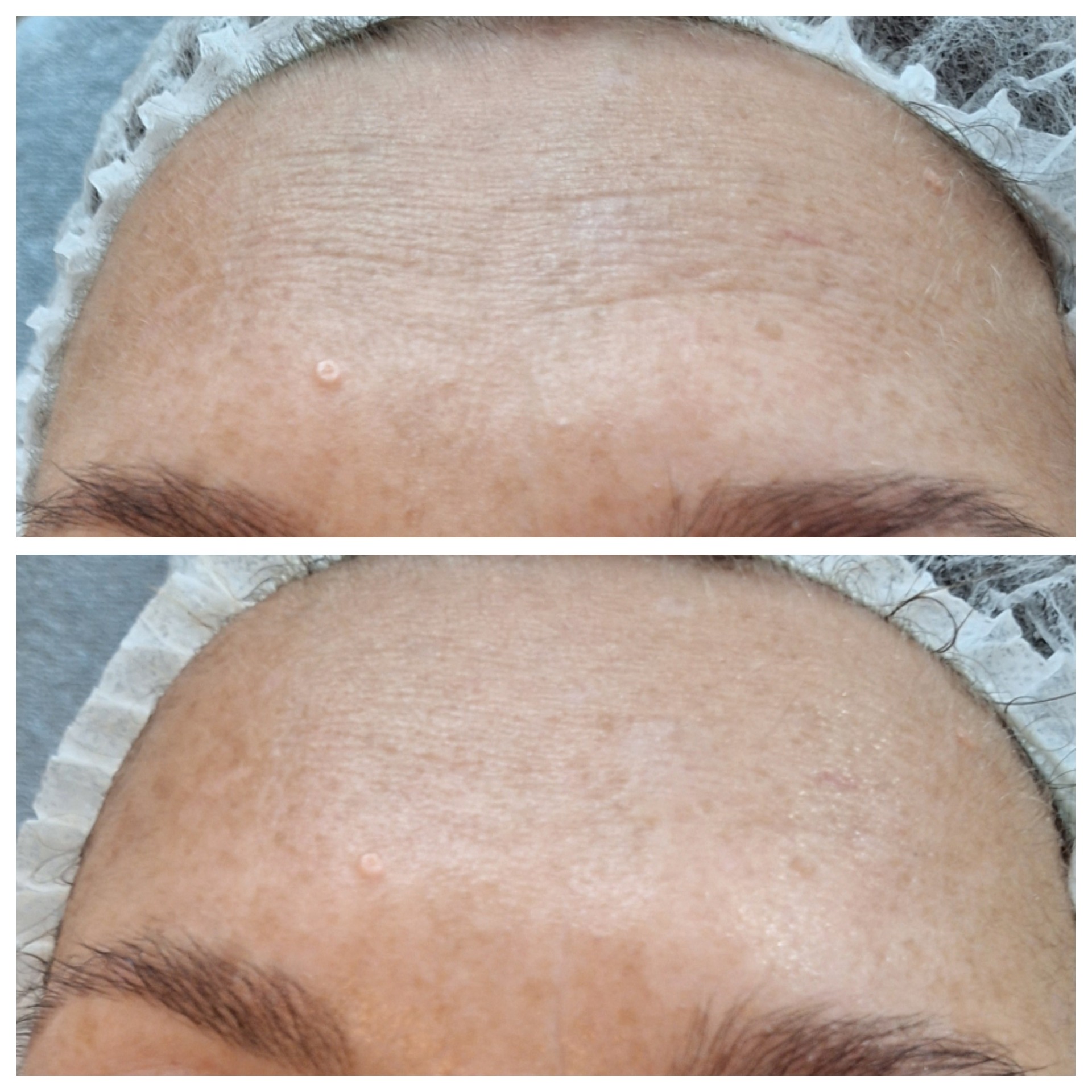 Porównanie skóry czoła przed i po zabiegu kosmetycznym, widoczne zmniejszenie zmarszczek i poprawa tekstury, włosy zabezpieczone czepkiem.