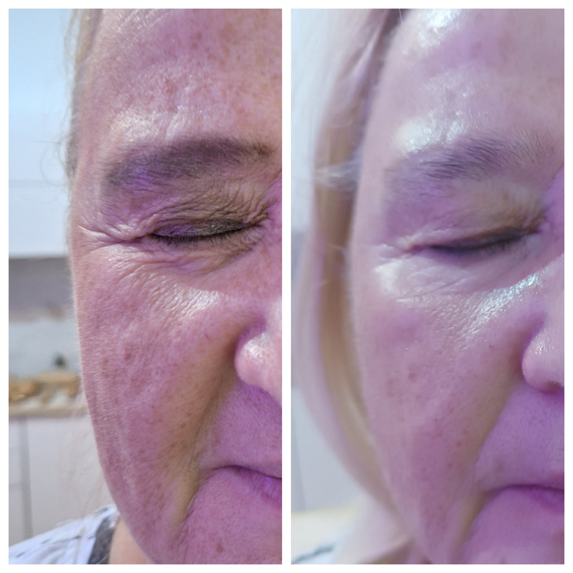 Zbliżenie na twarz kobiety z zamkniętymi oczami, po lewej stronie widoczne zmarszczki przed zabiegiem, po prawej stronie skóra po zabiegu, bardziej gładka i nawilżona.