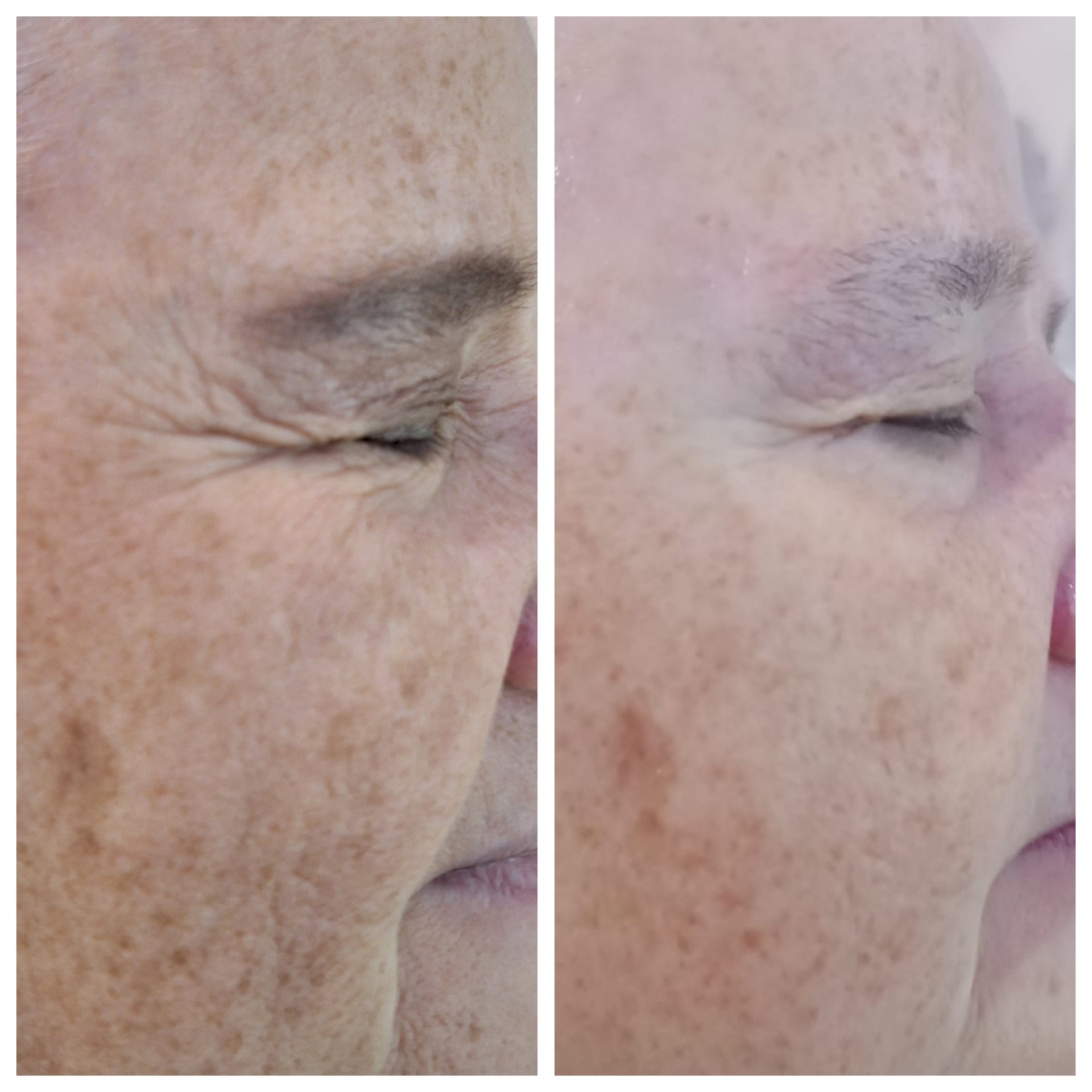 Porównanie skóry twarzy przed i po zabiegu kosmetycznym, widoczne zmniejszenie przebarwień i zmarszczek wokół oka.