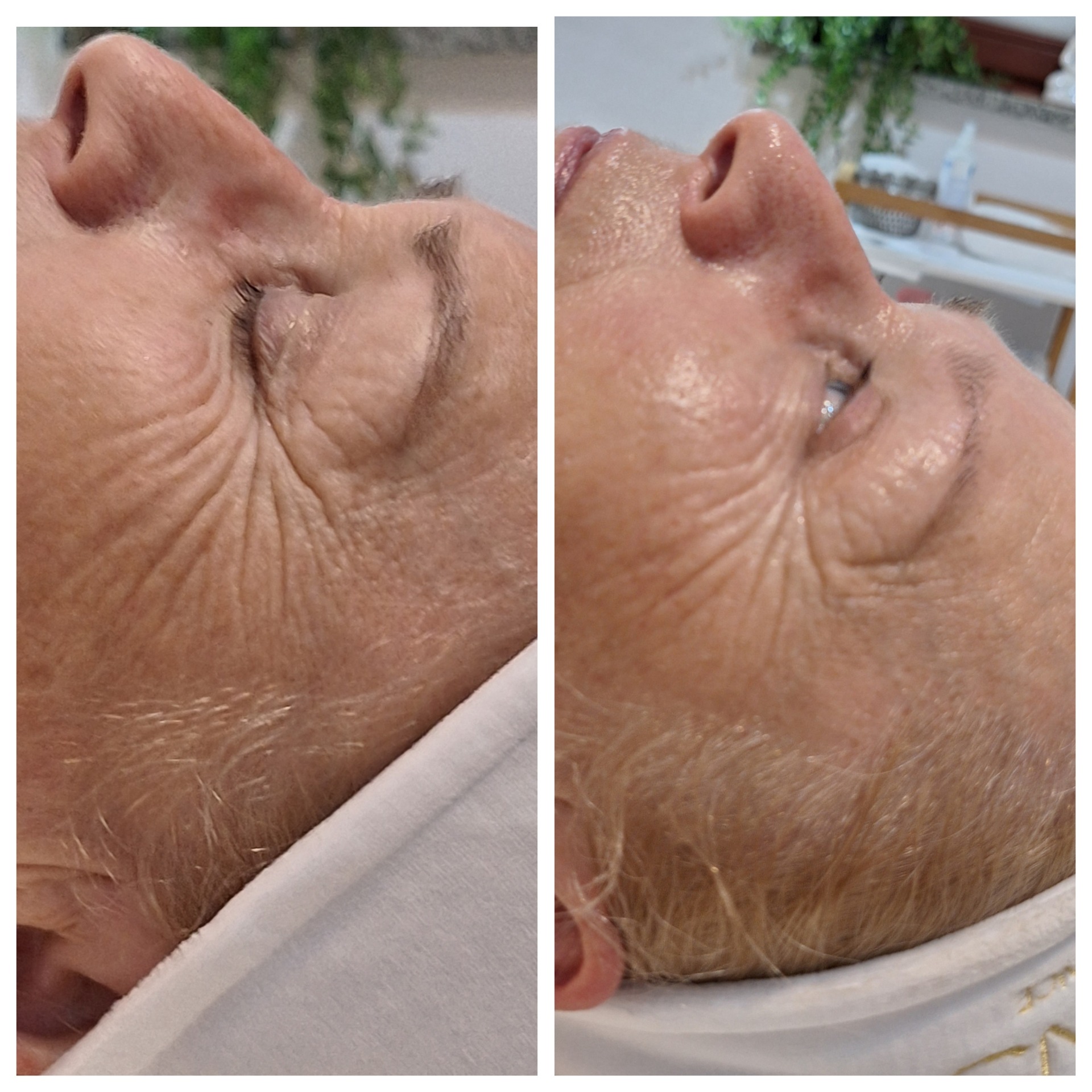 Zbliżenie na skórę twarzy kobiety przed i po zabiegu kosmetycznym, widoczne zmarszczki i nawilżenie skóry, porównanie efektów.