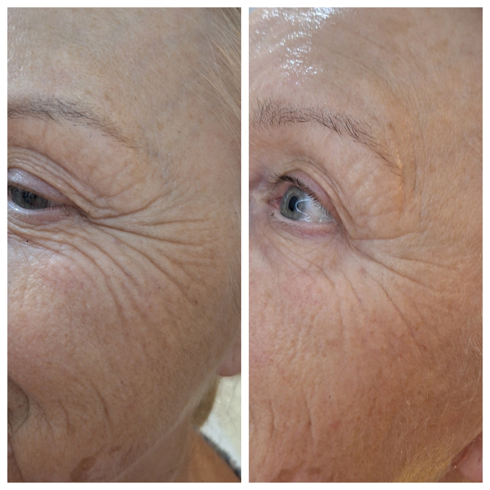 Zbliżenie na skórę wokół oka przed i po zabiegu kosmetycznym, widoczna redukcja zmarszczek i nawilżenie skóry.