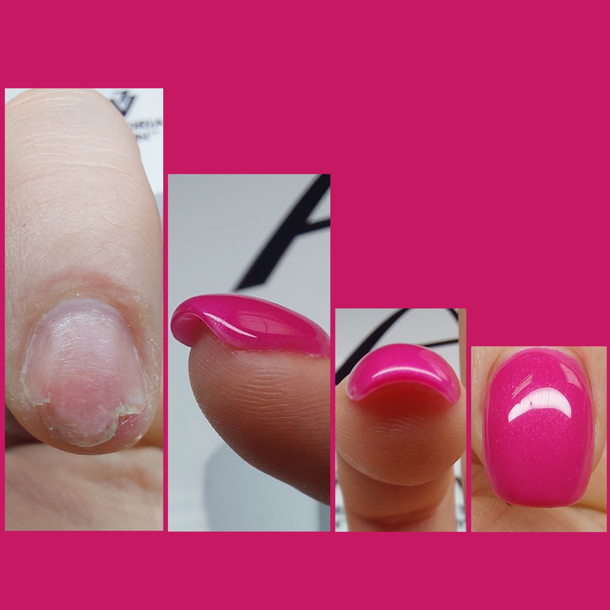 Zbliżenie na palec z uszkodzonym paznokciem przed zabiegiem i paznokcie po nałożeniu błyszczącego, różowego lakieru hybrydowego, prezentujące efekt końcowy.