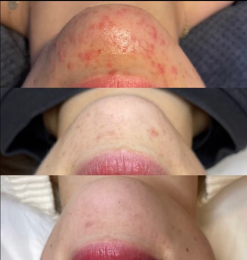 Trzy ujęcia brody i ust kobiety przed, w trakcie i po zabiegu redukcji trądziku. Widoczne zmiany w wyglądzie skóry, od zaczerwienionej z wypryskami, do jaśniejszej z mniejszą ilością zmian.