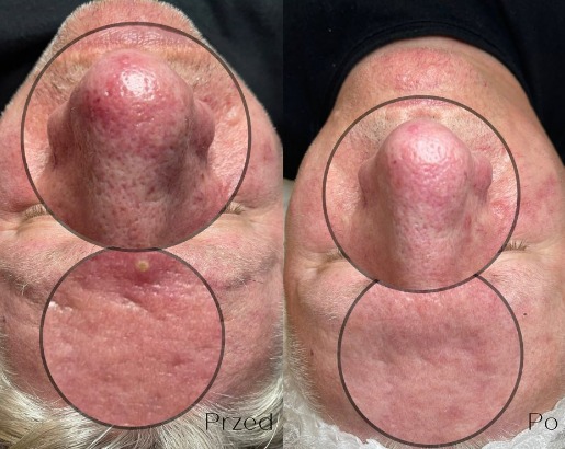 Zdjęcie porównawcze 'przed' i 'po' zabiegu na twarz, z bliska widoczne pory i zaczerwienienia skóry nosa oraz czoła, z zaznaczonymi obszarami problematycznymi.