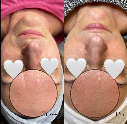 Zdjęcie porównawcze twarzy klientki przed i po zabiegu kosmetycznym, z zaznaczonymi obszarami skóry do oceny efektu.
