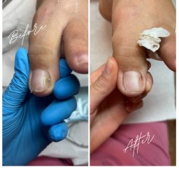 COSMETICA ROSA TERESA KUCHCIŃSKA - Praca naszej podolog Usunięcie onycholizy z płytki paznokciowej