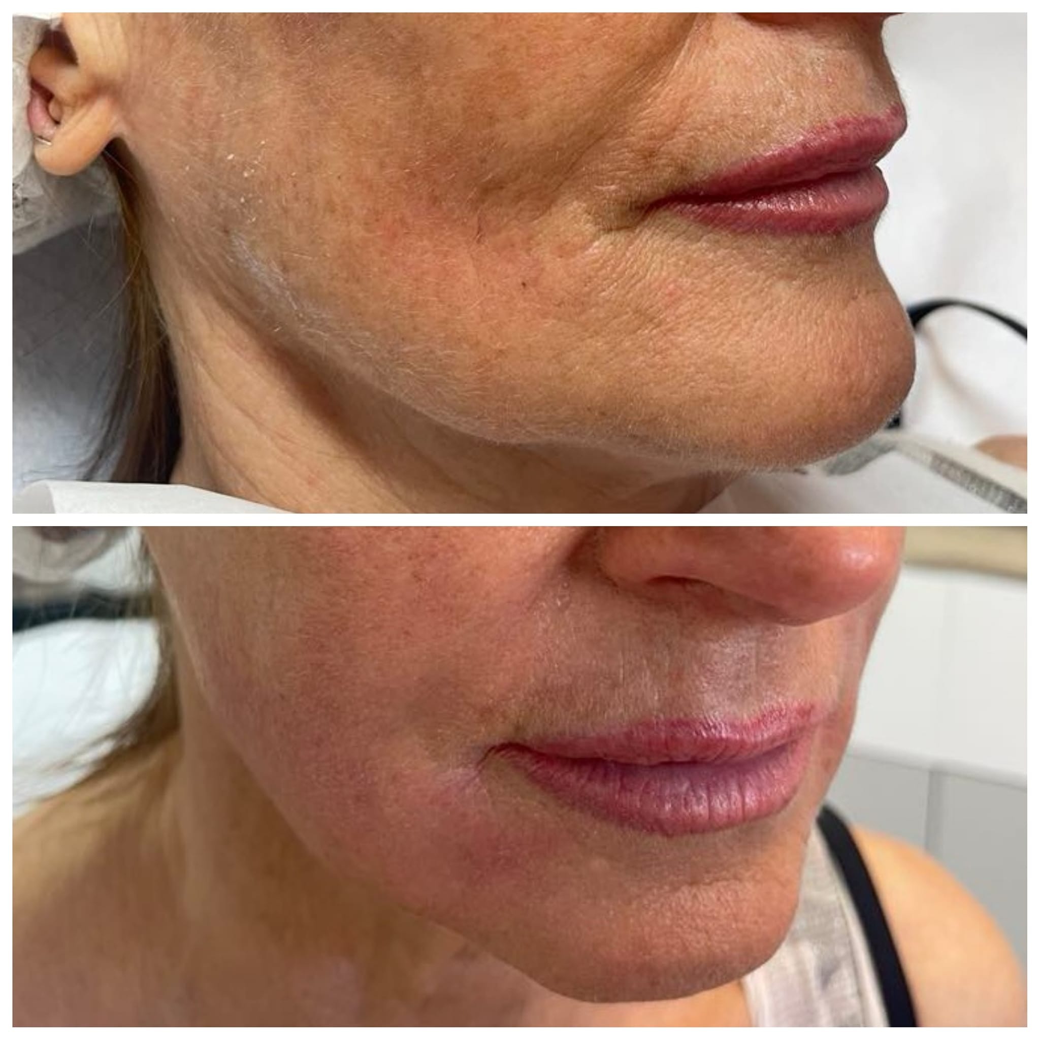 Dwa zbliżenia dolnej części twarzy kobiety przed i po zabiegu, widoczne zmiany w wyglądzie ust i skóry.