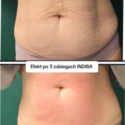Seria zabiegów INDIBA 