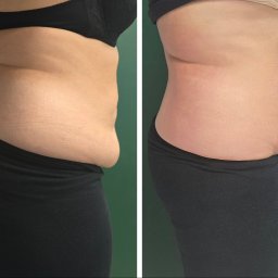 Seria zabiegów INDIBA 