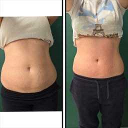 Seria zabiegów INDIBA 