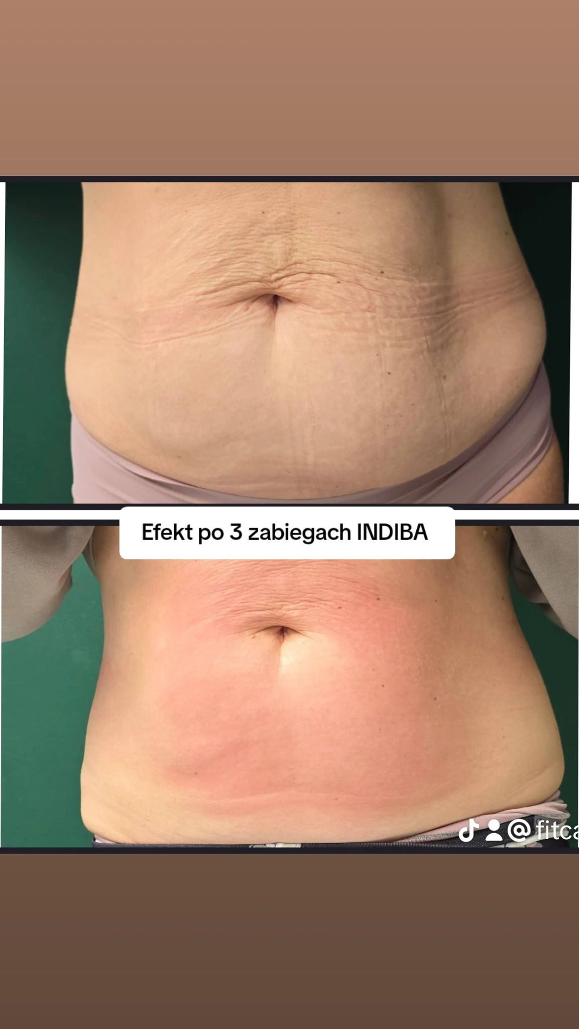 Seria zabiegów INDIBA