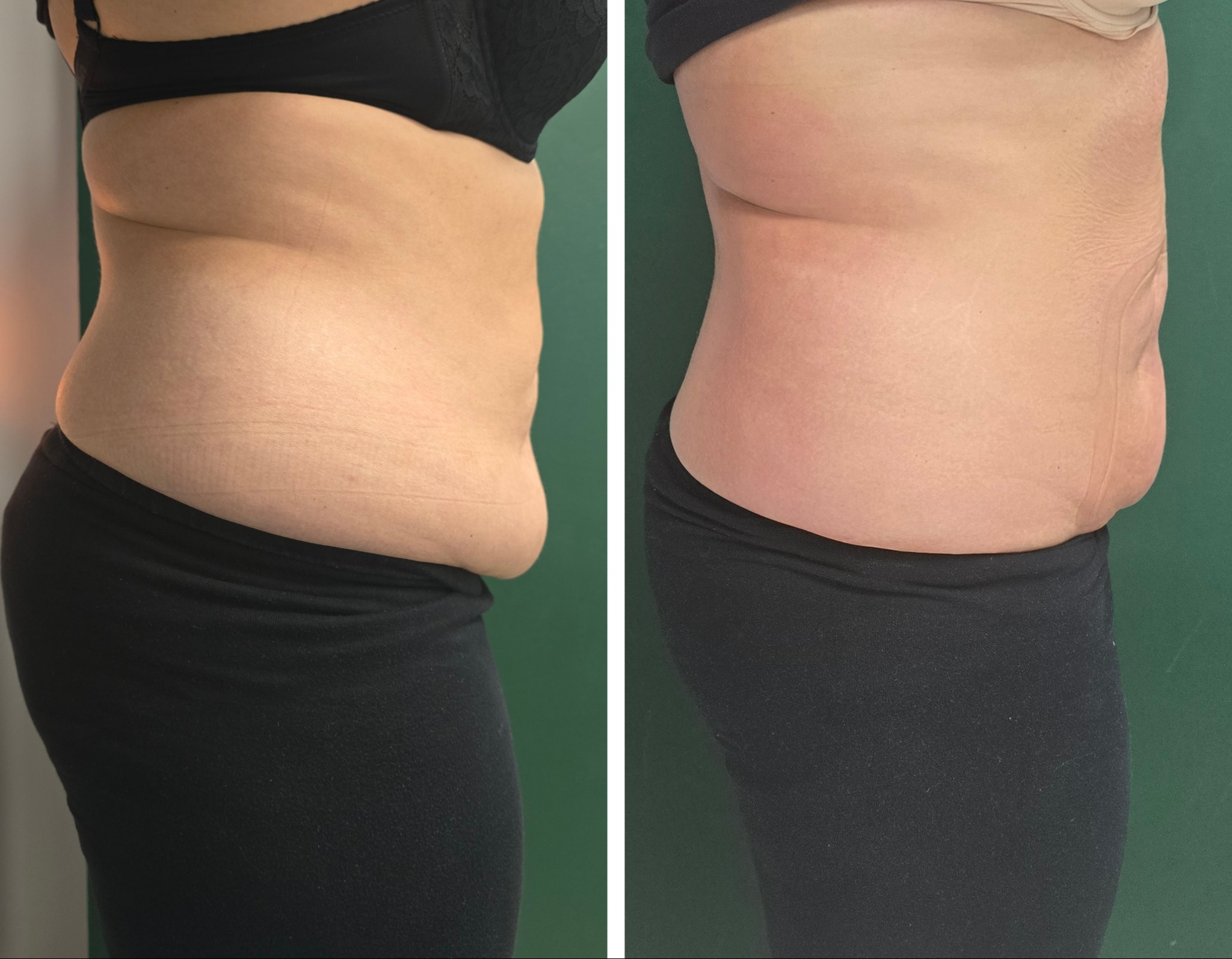 Porównanie sylwetki kobiety przed i po serii zabiegów INDIBA, widoczne zmniejszenie obwodu talii i wygładzenie skóry.