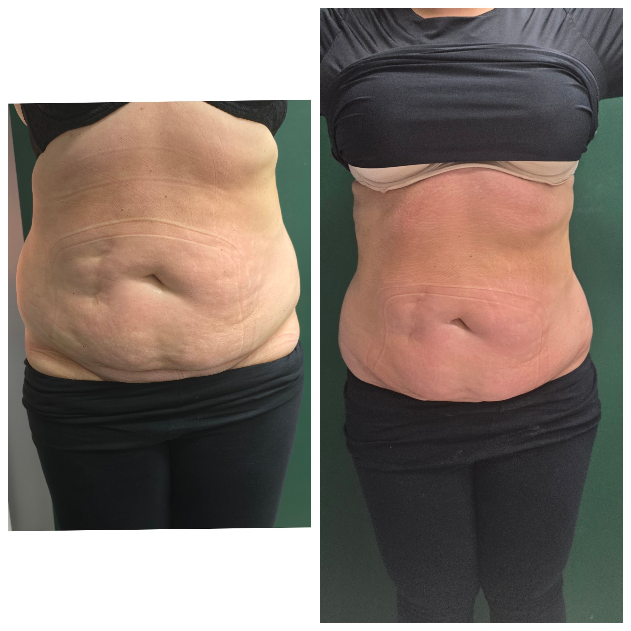 Zdjęcie typu 'przed i po' prezentujące sylwetkę kobiety od pasa w górę, ukazujące efekty serii zabiegów. Po lewej stronie widoczny stan początkowy, po prawej - efekt po zabiegach, z widoczną...