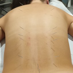 BOGDAN POCHCIOŁ NATURMED - Plecy pacjenta z igłami do akupunktury, widoczne ślady po wkłuciach, leżącego na białym prześcieradle w gabinecie.