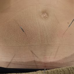 BOGDAN POCHCIOŁ NATURMED - Brzuch pacjenta z dwoma igłami do akupunktury, widoczne ślady po markerze na skórze.