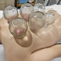 BOGDAN POCHCIOŁ NATURMED - Szklane bańki na plecach pacjenta podczas zabiegu, widoczne zaczerwienienia skóry pod bańkami.