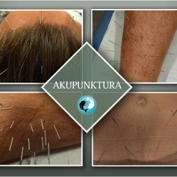 BOGDAN POCHCIOŁ NATURMED - Zabiegi akupunktury w gabinecie