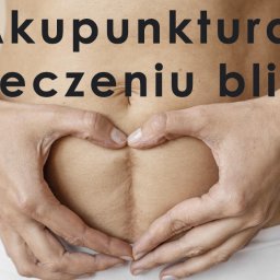 BOGDAN POCHCIOŁ NATURMED - Brzuch kobiety z widoczną blizną po operacji, ręce ułożone w kształt serca na tle beżowej ściany.