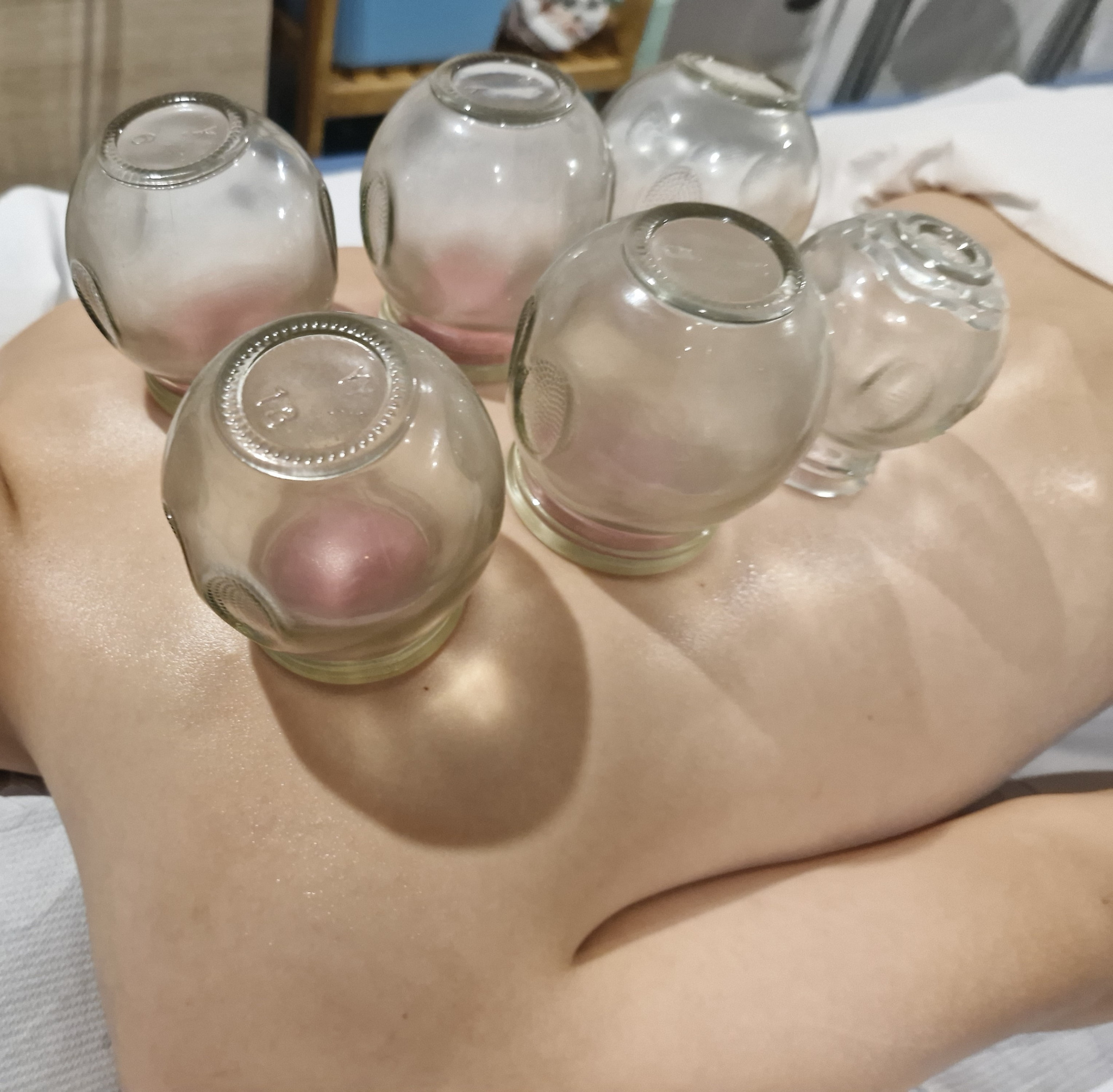 Szklane bańki na plecach pacjenta podczas zabiegu, widoczne zaczerwienienia skóry pod bańkami.