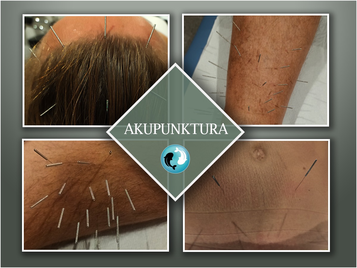 Zabiegi akupunktury w gabinecie