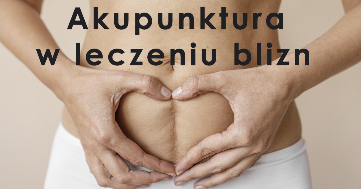 Brzuch kobiety z widoczną blizną po operacji, ręce ułożone w kształt serca na tle beżowej ściany.