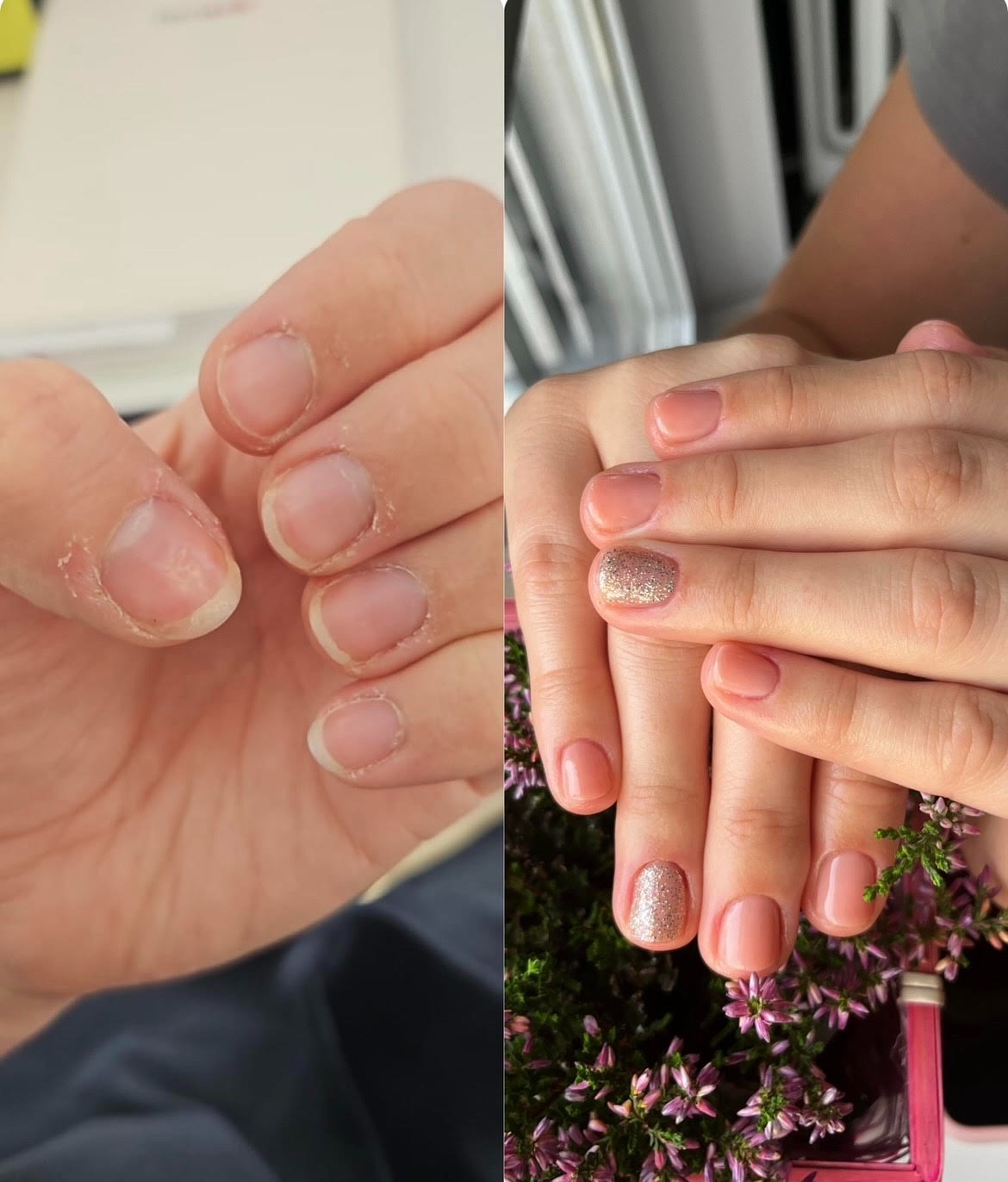 Porównanie stanu paznokci przed i po zabiegu: po lewej zaniedbane dłonie z obgryzionymi skórkami, po prawej dłonie z delikatnym, różowym manicure z brokatowym akcentem na dwóch palcach, ozdobione...