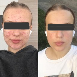Kale Poradnia dietetyczna - Zdjęcie typu 'przed i po' przedstawiające twarz młodej kobiety z zakrytymi oczami, po lewej z widocznymi zmianami skórnymi, po prawej z wyraźną poprawą stanu cery, obie wersje z białymi słuchawkami...
