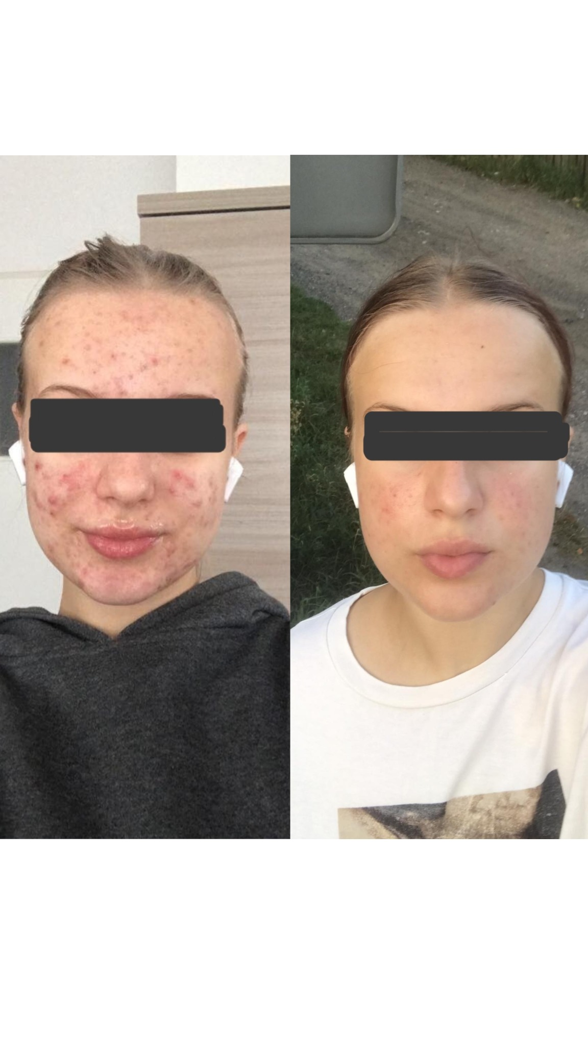 Zdjęcie typu 'przed i po' przedstawiające twarz młodej kobiety z zakrytymi oczami, po lewej z widocznymi zmianami skórnymi, po prawej z wyraźną poprawą stanu cery, obie wersje z białymi słuchawkami...