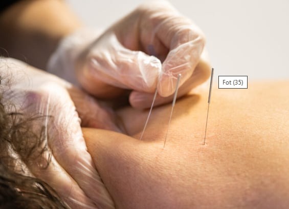 Akupunktura: trzy cienkie igły wkłute w skórę pacjenta, dłoń terapeuty w lateksowej rękawiczce stabilizuje jedną z igieł.