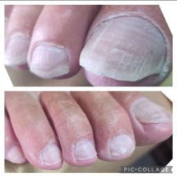 JOWIN JOANNA WINKIEL - Zbliżenie na stopy przed i po zabiegu. Widoczne nierówne paznokcie przed i gładkie, wypielęgnowane po zabiegu. Fotografia w neutralnej tonacji.