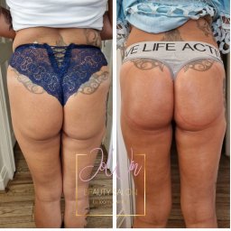JOWIN JOANNA WINKIEL - Zdjęcie 'przed i po' prezentujące efekt zabiegu na ciało. Po lewej stronie widoczne pośladki przed zabiegiem, po prawej - po zabiegu, z zaznaczonymi liniami.