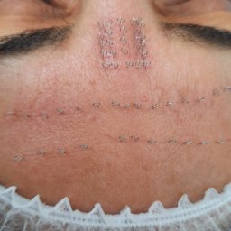 Harmonia Piękna Gabinet Kosmetyczny Karolina Kenkel - Świeżo po zabiegu z użyciem nici liftingujących na czole pacjentki w Lesznie, widoczne ślady wkłuć i same nici.