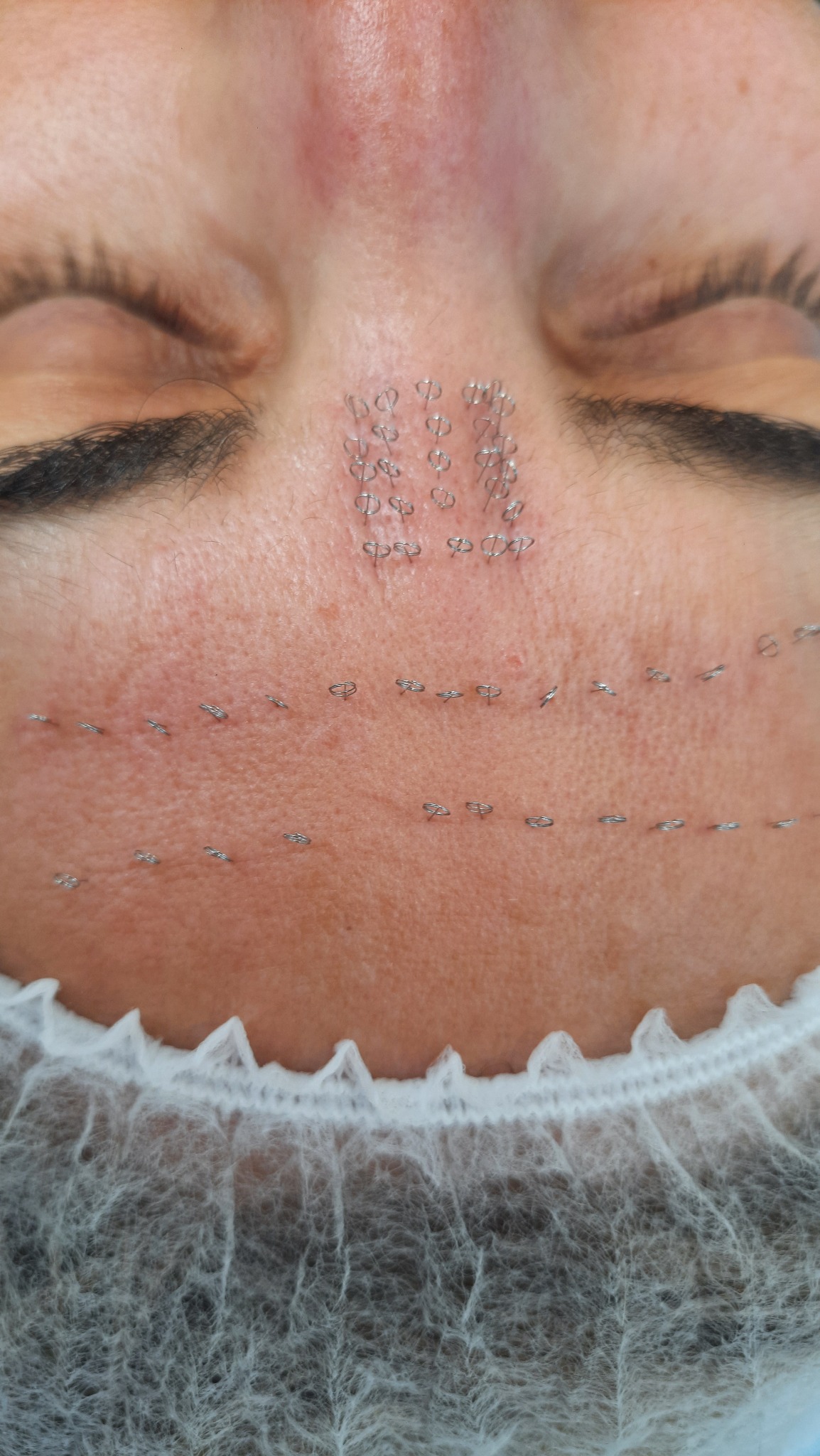 Świeżo po zabiegu z użyciem nici liftingujących na czole pacjentki w Lesznie, widoczne ślady wkłuć i same nici.