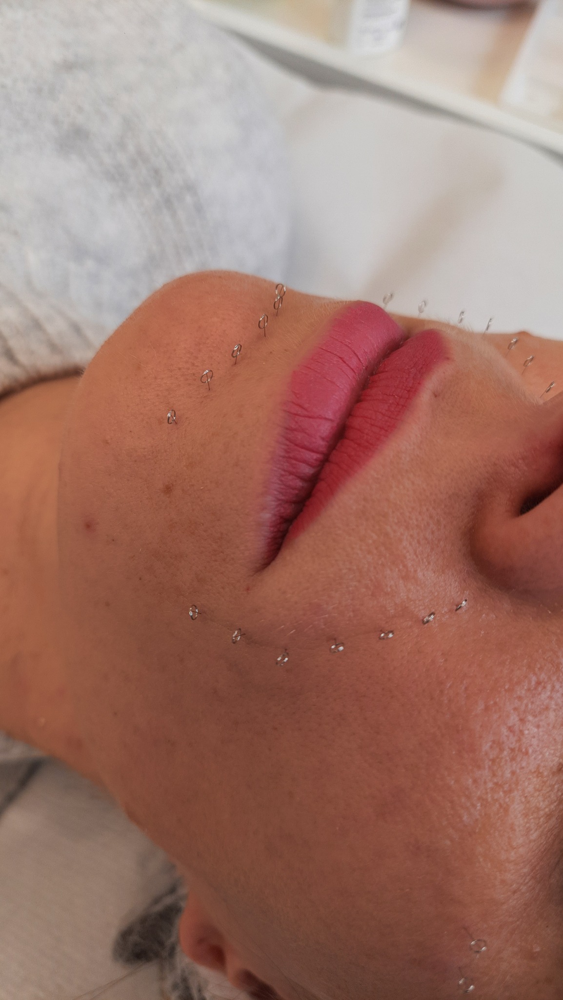 Twarz kobiety z zaznaczonymi punktami na skórze wokół ust, przygotowana do zabiegu z zakresu medycyny estetycznej, widoczne czerwone usta i fragment białego podkładu.