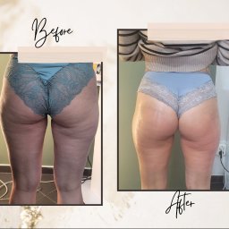 Nutrilove Klinika Modelowania Sylwetki - Modelowanie sylwetki 'lifting pośladków oraz tylnej części ud' efekt po 6 zabiegach