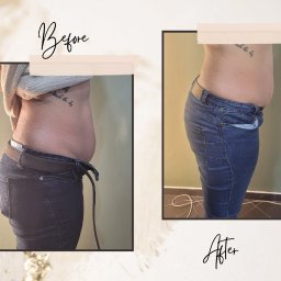 Nutrilove Klinika Modelowania Sylwetki - Modelowanie sylwetki 'lifting brzucha z boczkami' efekt po 1 zabiegu, jeszcze 5 przed nami