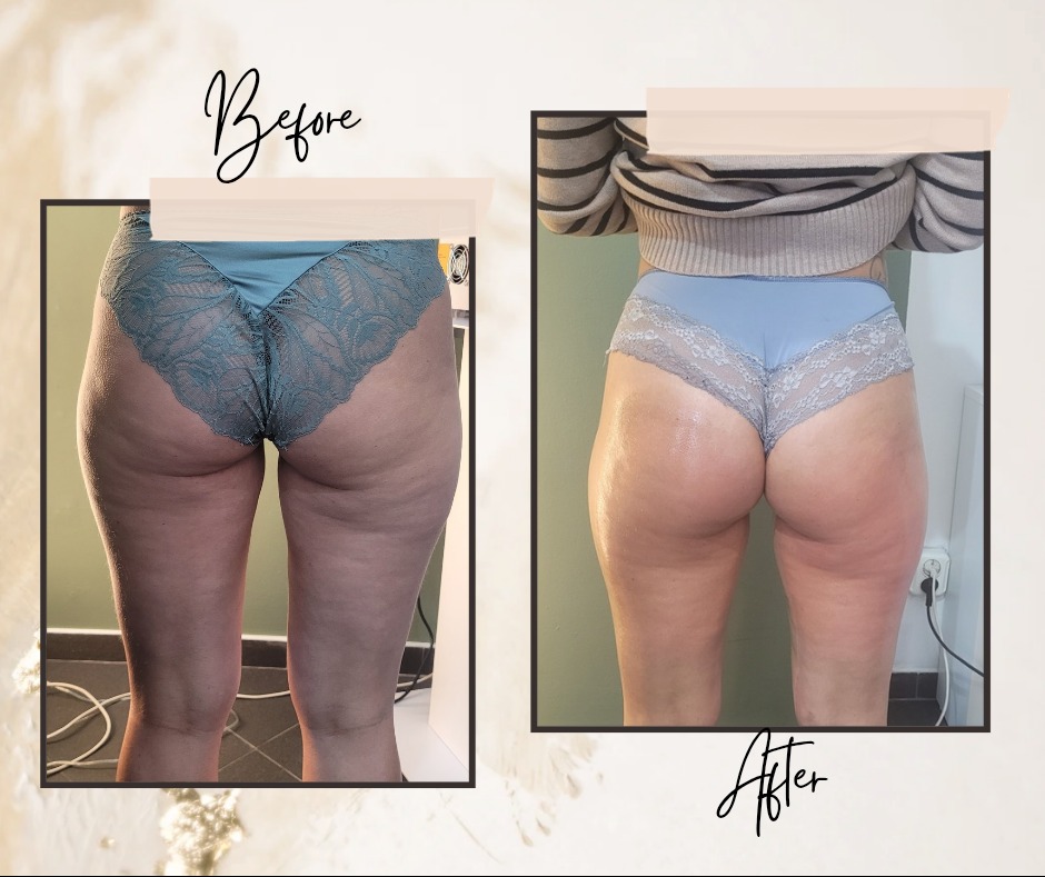 Modelowanie sylwetki 'lifting pośladków oraz tylnej części ud' efekt po 6 zabiegach