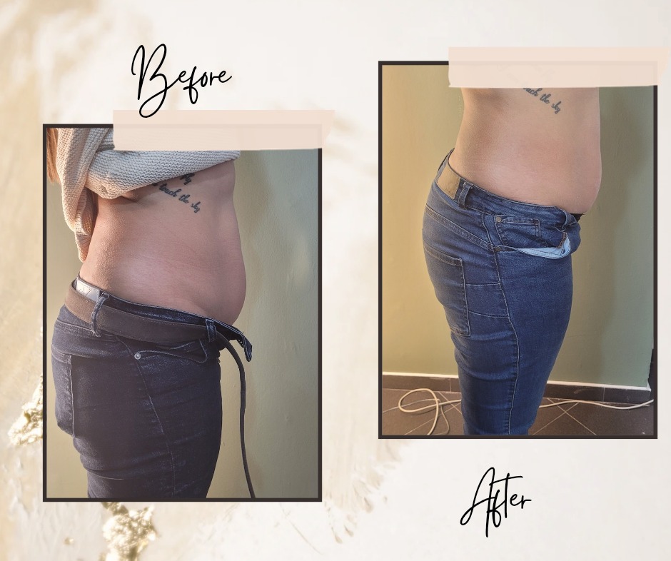 Modelowanie sylwetki 'lifting brzucha z boczkami' efekt po 1 zabiegu, jeszcze 5 przed nami