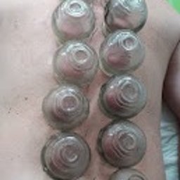 Synergia Centrum Żary - Fizjoterapia - Rehabilitacja - Masaż - Plecy mężczyzny z przyssawkami próżniowymi ułożonymi wzdłuż kręgosłupa, widoczne zaczerwienienia skóry wewnątrz naczyń.