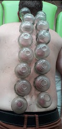 Plecy mężczyzny z przyssawkami próżniowymi ułożonymi wzdłuż kręgosłupa, widoczne zaczerwienienia skóry wewnątrz naczyń.