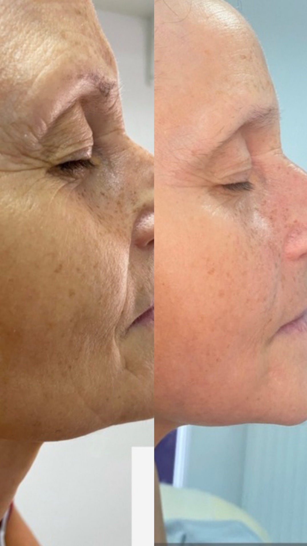 Porównanie stanu skóry twarzy przed i po zabiegu, widoczne zmniejszenie zmarszczek i przebarwień, profil kobiety na jasnym tle.