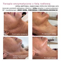 Oferuje nieinwazyjne terapie enzymatyczne dla cery dojrzałej połączone z aplikacją aparaturą bądź w razie przeciwskazań bez jej użycia.