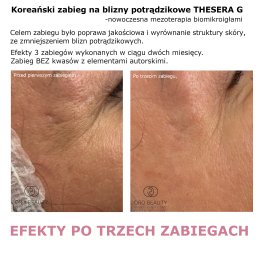 Oferuję kompleksowe terapie blizn potrądzikowych z wykorzystaniem technik łączonych, ale bez igieł, bólu i rekonwalescencji. To przykład efektów pierwszego etapu przebudowy skóry. 
